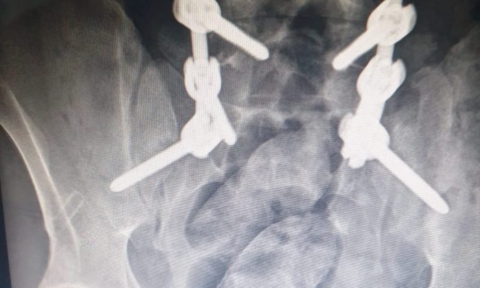 İranlı şüphelinin midesinden 130 gram uyuşturucu çıktı